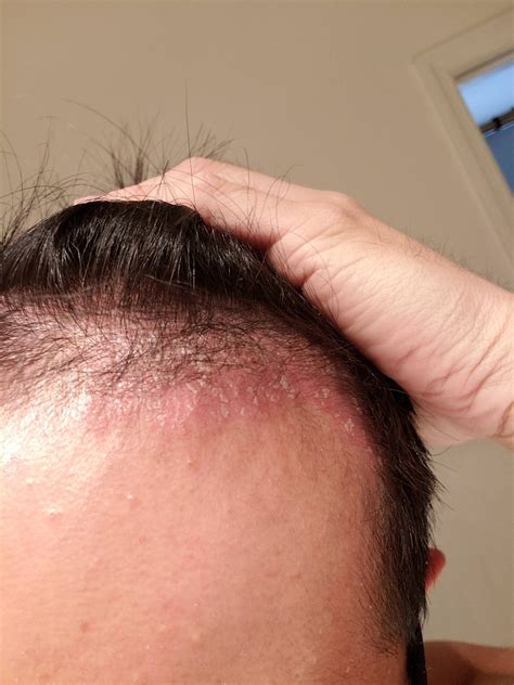 What To Do For Psoriasis On Scalp