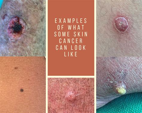 Examples Of What Some Skin Cancer Can Look Like Appalachian Spring