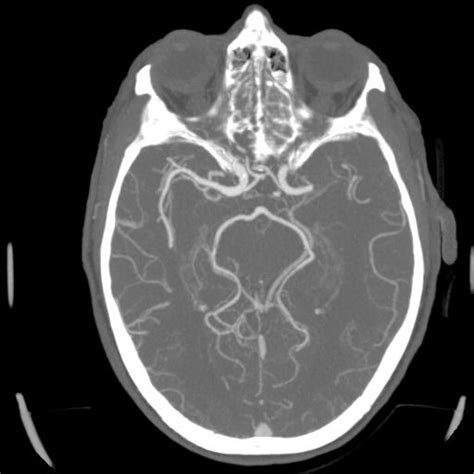 Acute Ischemic Stroke With Large Artery Occlusion On Ct Angiogram The