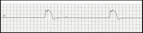 Float Nurse: EKG Rhythm Strips 91 Various Agonal Rhythms