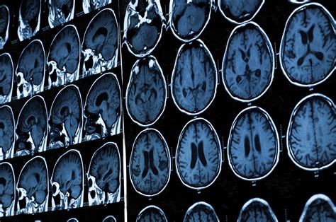Some people refer to a ct scan as a cat scan. Could brain scans help predict schizophrenia? - News ...