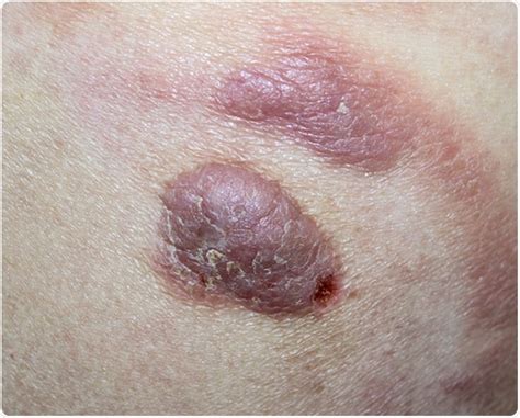 What Is Cutaneous T Cell Lymphoma