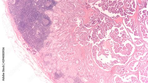Thyroid Cancer Metastasis Photomicrograph Microscopic Image Of A