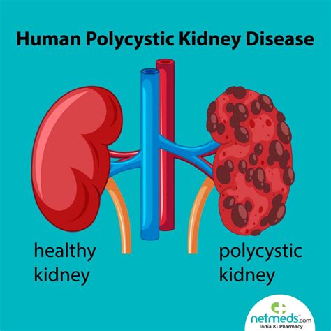 Polycystic Kidney Disease Causes Symptoms And Prevention