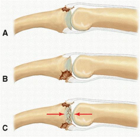 Operative Management Of Pip Dislocations And Fracture Dislocations