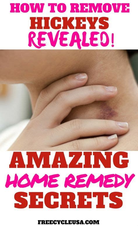 diy how to remedy hickeys how to get rid how to hide hickeys get rid of hickies