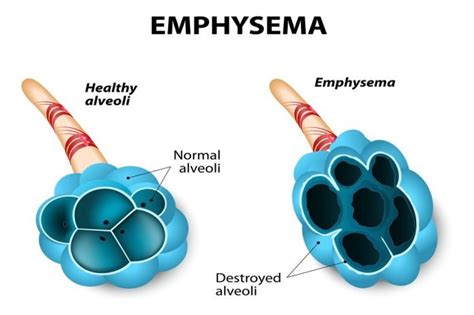 Emphysema Definition Symptoms Causes Diagnosis Types Stages