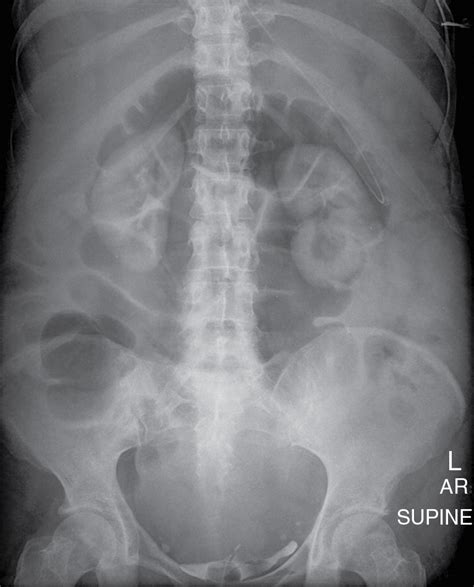 Abdominal Radiography Radiology Key