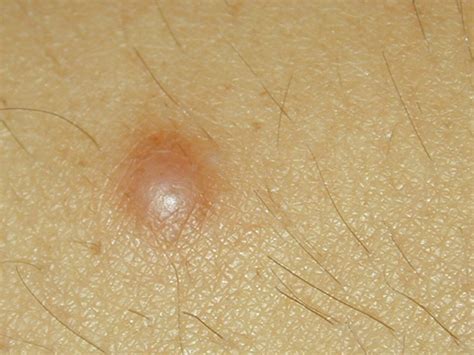 👉 Dermatofibroma Pictures Removal Treatment Symptoms January 2022