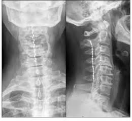 Antero Posterior And Lateral Radiographic View Of The Cervical Spine To