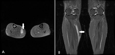 The Value Of Ultrasound In The Preoperative Diagnosis Of Muscle