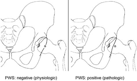 Figure 1 From Radiographic Markers Of Acetabular Retroversion