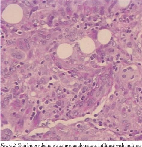 Figure 2 From A Rare Case Of Subcutaneous Sarcoidosis In Patient With