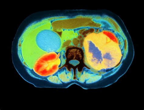 Col Ct Scan Showing Kidney Cancer Axial Section Photograph By Dept