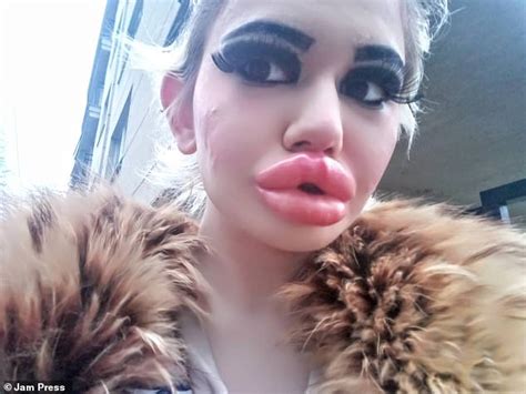Woman 22 Who Has Spent Thousands Quadrupling The Size Of Her Lips In