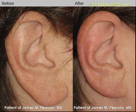 Dr James Pearson Facial Plastic Surgery Ear Plastic Surgery Facial