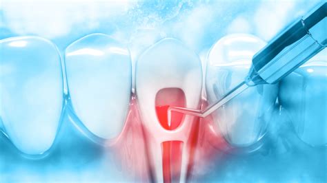 Laser Dentistry In Endodontic Treatments Dr Suffoletta Dentistry