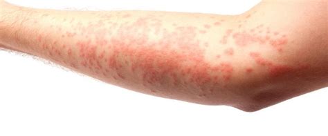 Skin Rashes Causes Symptoms And Treatment