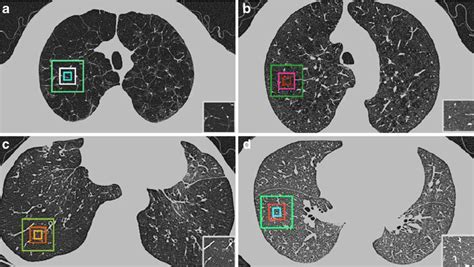 Axial Thin Section Ct Scans Of The Chest Window Level − 800 Hu