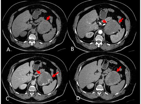 Dynamic Transverse Ct Scan Of Adrenal Hemangioma A In Precontrast