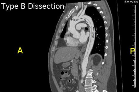 Case Study Endovascular Treatment Of Type B Aortic Dissection Consult Qd