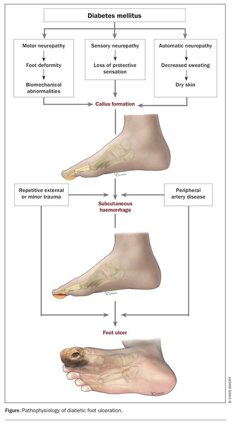 The Diabetic Foot From Ulcer To Infection Medicine Today