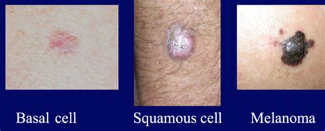 Skin Cancer Malignant Tumors Of The Skin Flashcards Quizlet