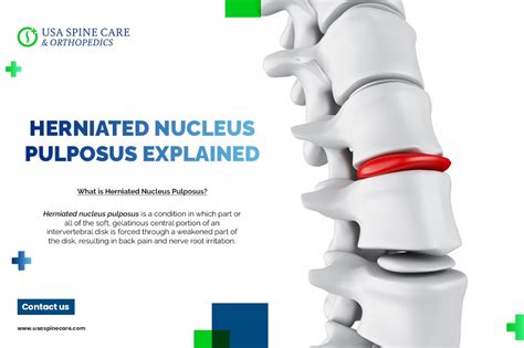 Herniated Nucleus Pulposus Explained Usa Spine Care Laser Spine Surgery