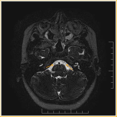 Abducens Nerve Mri Radiology Imaging