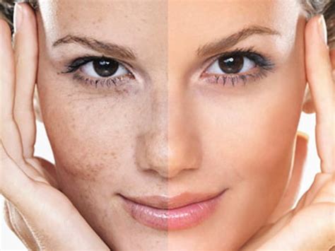 5 Secret Solutions To Manage Uneven Skin Tone