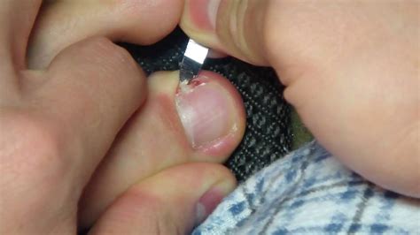 2nd attempt at removing ingrown toenail - YouTube