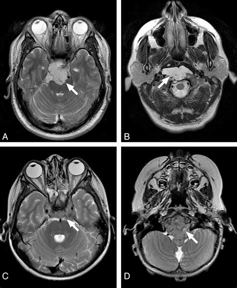 Ischemic Transient Ischemic Attack Mri