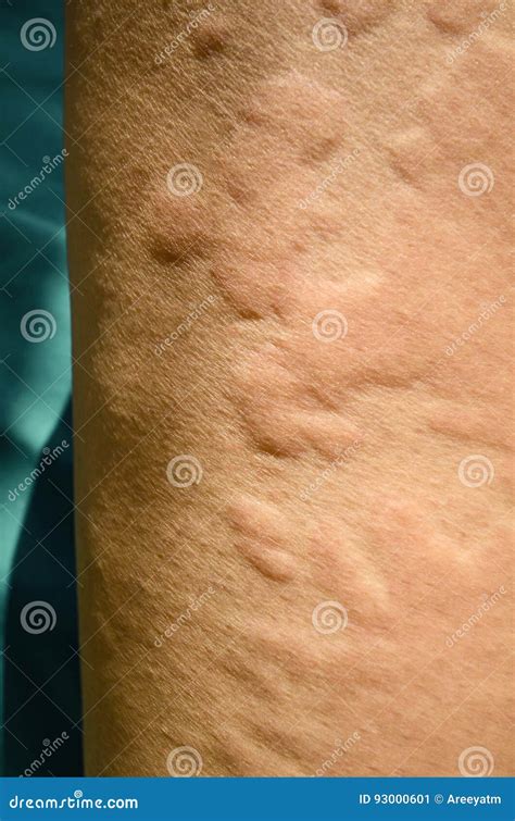 Skin Rash And Blisters On Body Shingles On Men Herpes Zoster Royalty