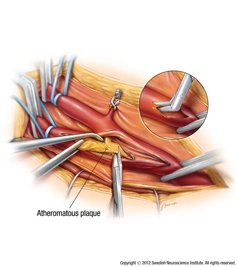 The carotid arteries are a pair of large blood vessels that carry blood from the heart to the brain. What is carotid artery disease? | Swedish Medical Center Seattle and Issaquah