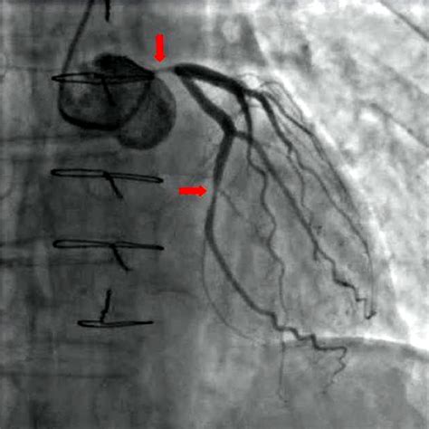 Fileangiography Coronary Stenosis 01 Wikimedia Commons
