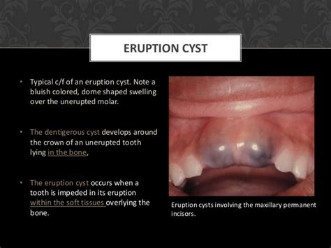 Cyst Of Jaw