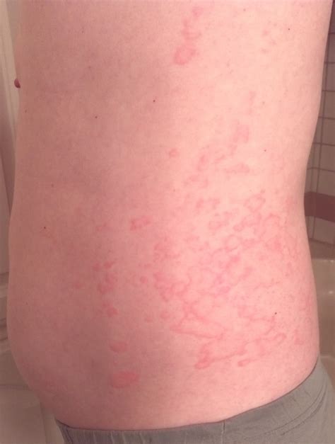 Allergic Reaction Rash To Laundry Detergent Causes Symptoms And Treatment Martlabpro