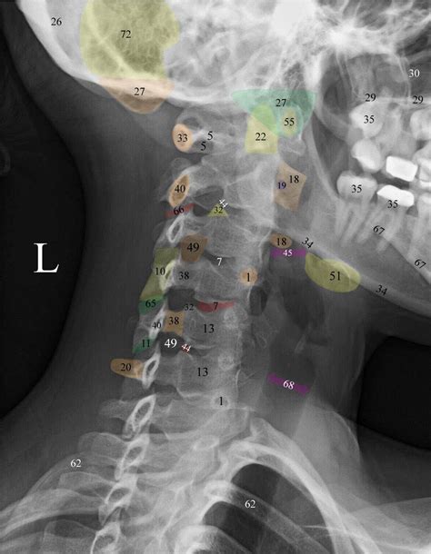 Normal Radiographic Anatomy Of The Cervical Spine Anatomy Medical