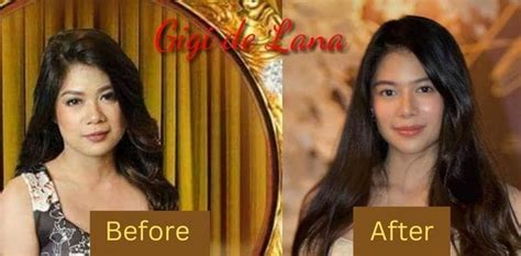 Gigi De Lana Before Surgery Egie Alarcan Posted Gigis Before And