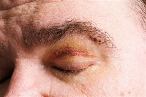 Close View Of A Bruise Near The Eye The Face Of A Man With A Hematoma