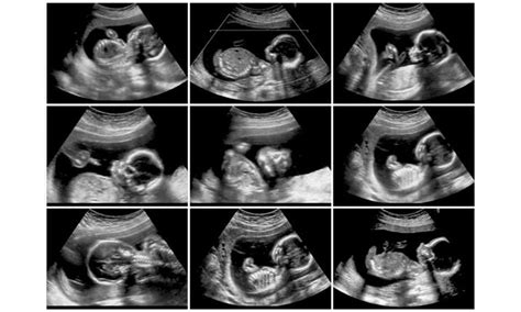 Detail Scan Doktor Tengok A Z Perkembangan Bayi Waktu Terbaik