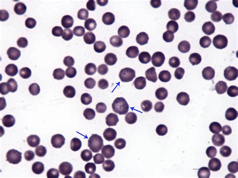 Al frotis sanguini es va observar anisocitosi eritròcits de diferents