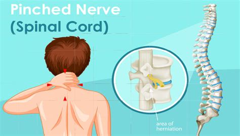 Pinched Nerve Pain Chicago Learn About Blogtopic