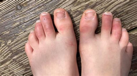 Dermatologist Explains If Covid Toes Skin Rashes Are Symptoms Tied