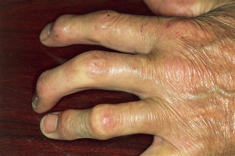Managing Psoriatic Arthritis Updated 2018 Recommendations From Acrnpf