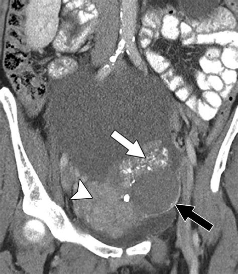 Ct Features Of Ovarian Tumors Defining Key Differences Between Serous