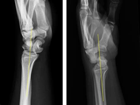 Lateral View Of The Wrist A Line Drawn Along The Long Axis Of The