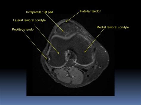 Knee Muscle Anatomy Axial Mri Figure 12 From Normal Mr Imaging