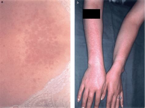 Treatment Of Polymorphic Light Eruption Ling 2003