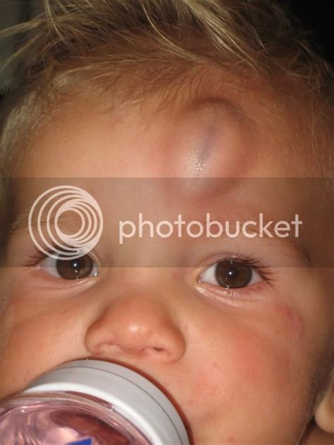 Bruised Child Babycenter